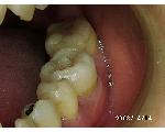 写真で見る最新歯牙移植症例集